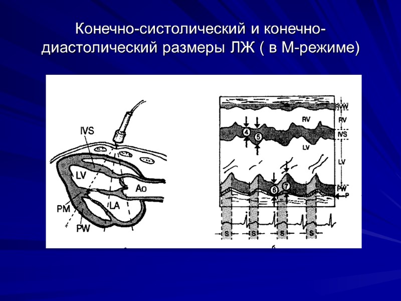 Конечно-систолический и конечно-диастолический размеры ЛЖ ( в М-режиме)